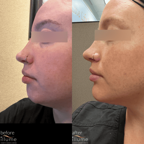 Chin Filler Illume Cosmetic Surgery MedSpa