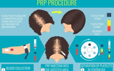 PRP For Hair Loss