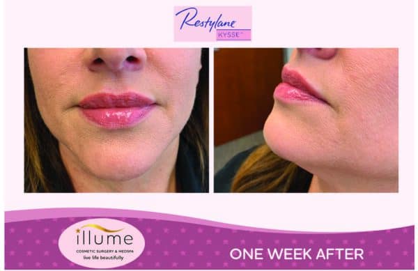 Get “KYSSED” with our New Restylane Lip Filler!!
