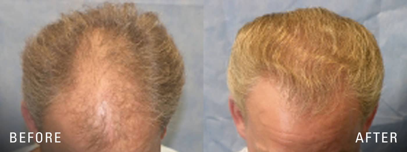 Hair Restoration and Hair Transplant | Illume Cosmetic Surgery & MedSpa