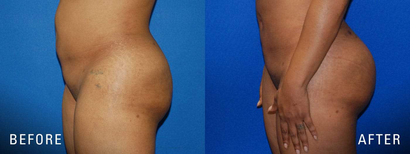 MeTime - Brazilian butt lift with fat transfer versus implants