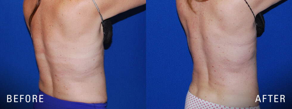 Waukesha And Milwaukee Liposuction Illume Cosmetic Surgery And Medspa 