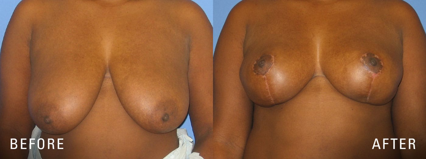 Breast Reduction with Illume