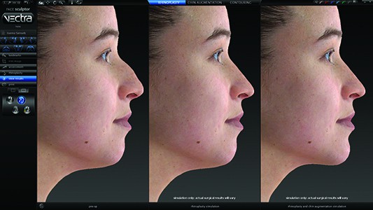 RHINO CORRECT NOSE MODELER TO IMPROVE SHAPE AND BREATHING NASAL CORRECTOR