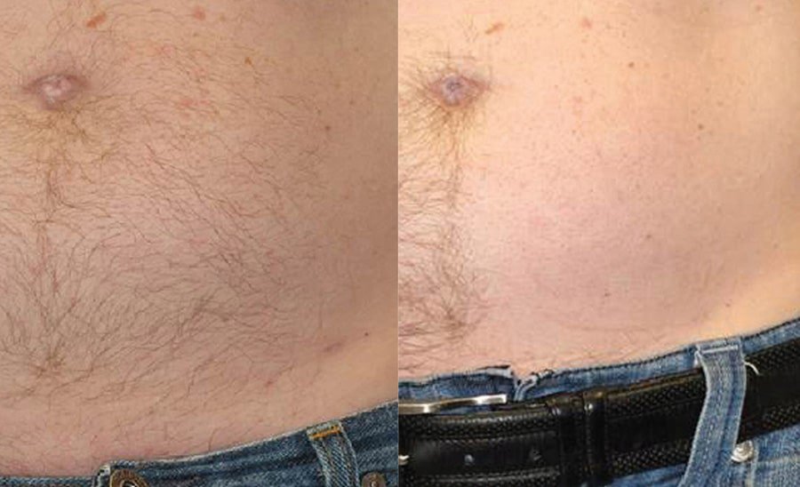 Male Laser Hair Removal Milwaukee Illume Cosmetic Surgery MedSpa