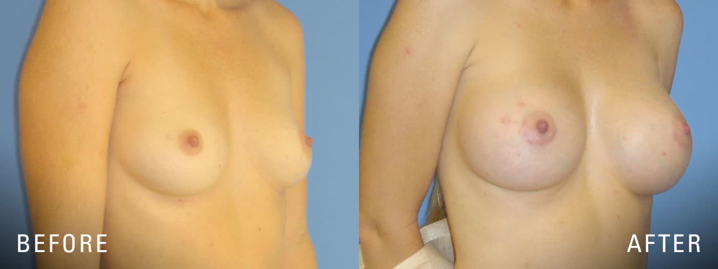 Illume Breast Augmentation