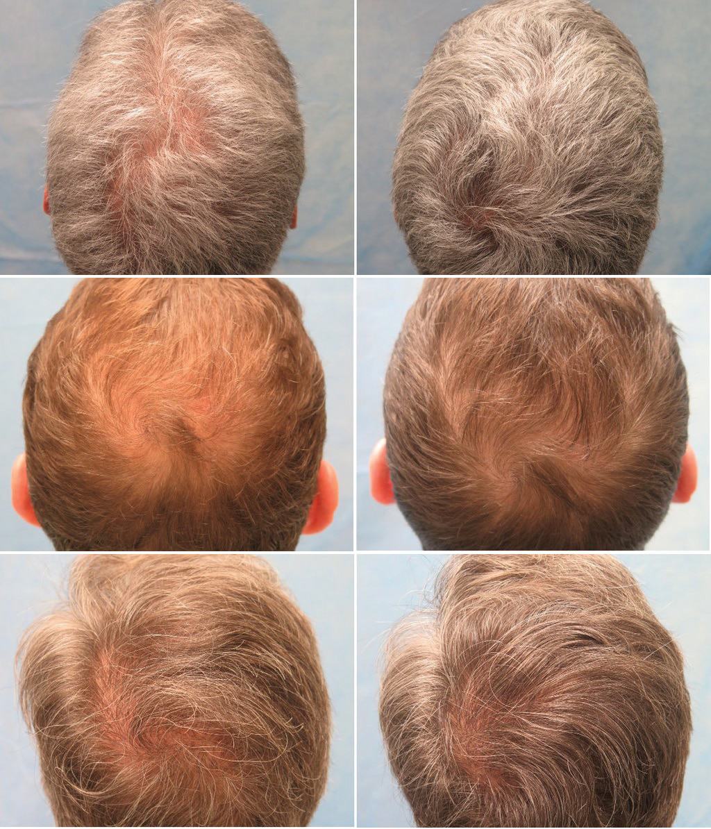 PRP For Hair Loss Milwaukee | Illume Cosmetic Surgery & MedSpa