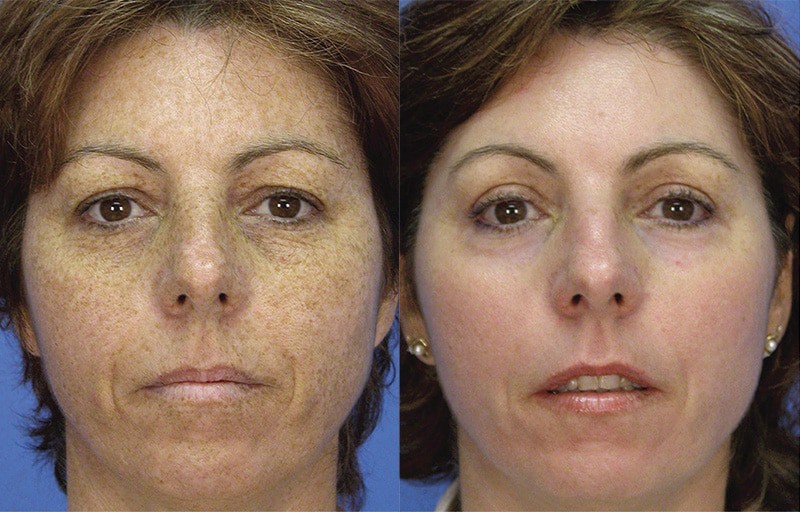 Before & after microlaser peel