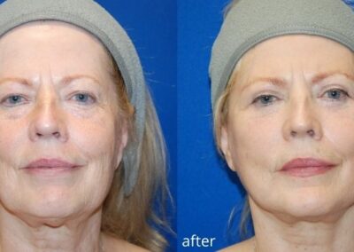 Before and after images showcasing a woman's face after undergoing a facelift procedure at Illume Cosmetic Surgery, highlighting skin tightening and rejuvenation.