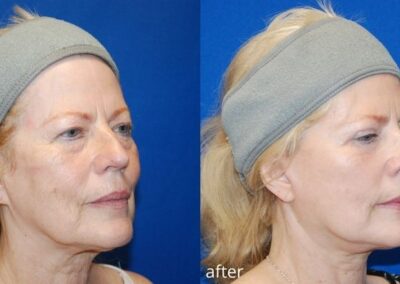 Before and after image showing the results of a facelift cosmetic surgery procedure at Illume Cosmetic Surgery, highlighting face and neck improvements.