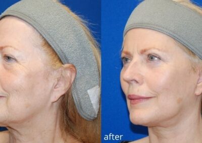 Before and after photo of a female patient who underwent a facelift cosmetic surgery, showcasing improved facial contours and reduced signs of aging at Illume Cosmetic Surgery.