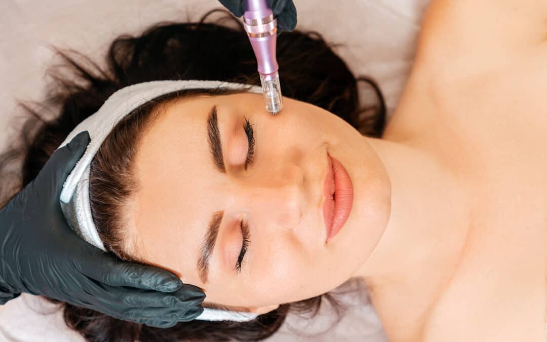 Microneedling, Major Results: How to Get Younger, Fuller, Smoother Skin with Microneedling