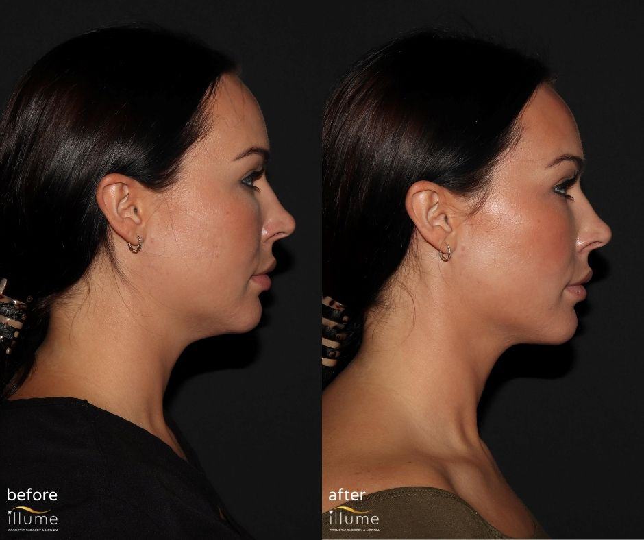 jo My Ellevate B&A good (1)