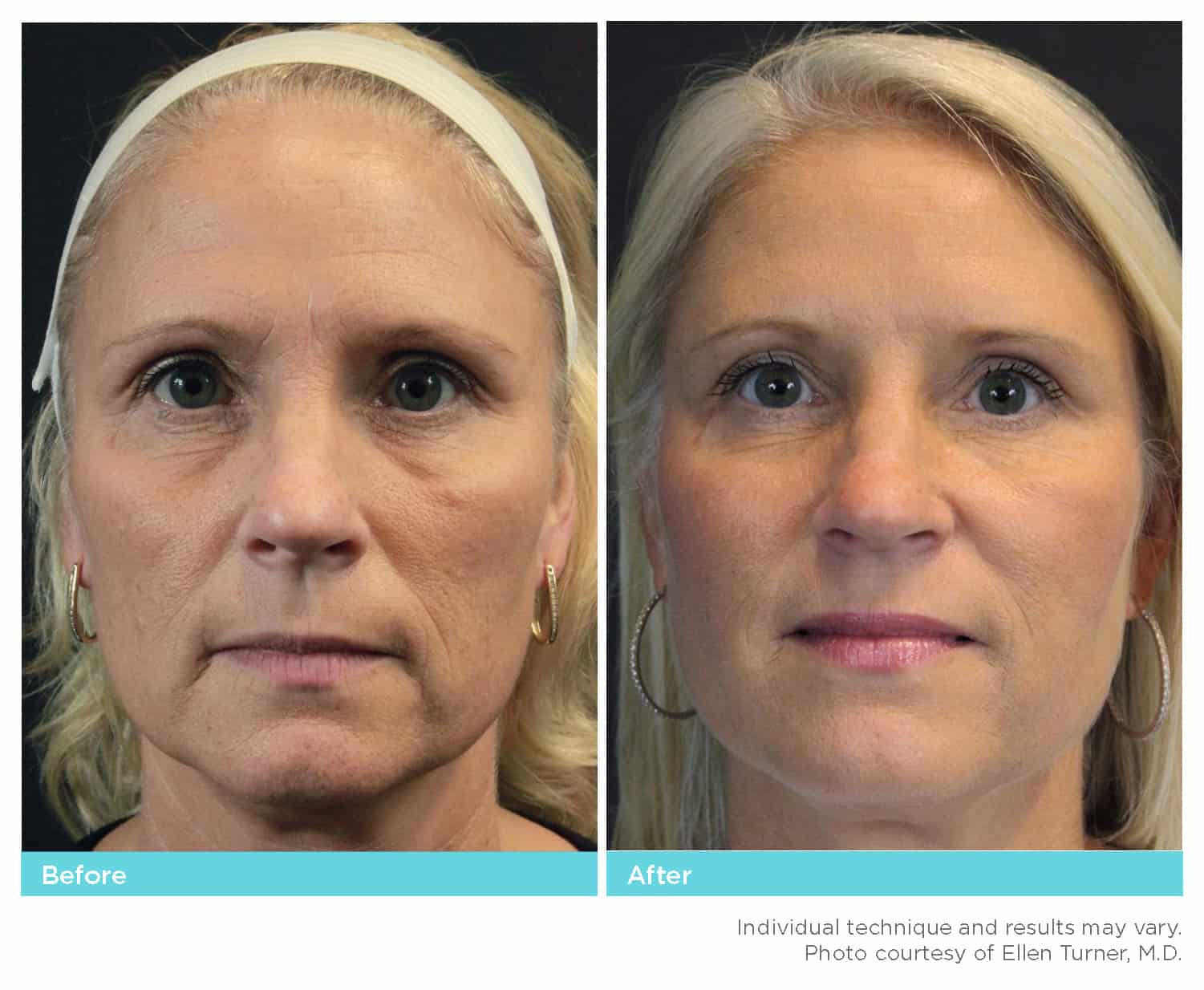 InstaLift B&A 04