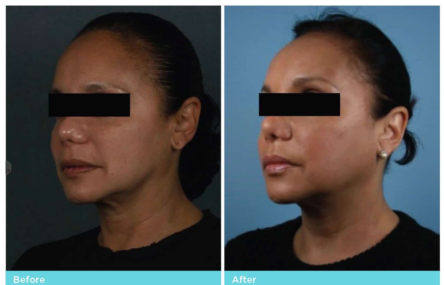 InstaLift B&A 05