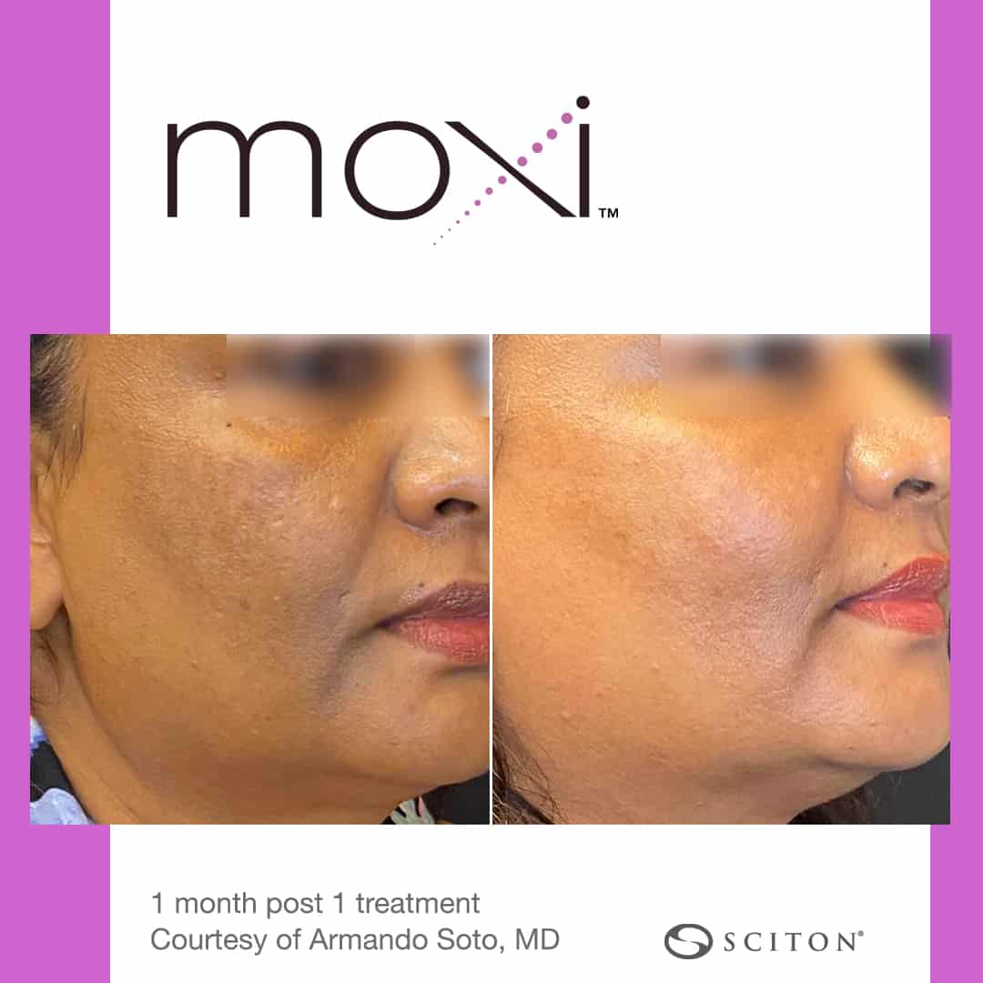 MOXI Laser Treatment Illume Cosmetic Surgery & MedSpa