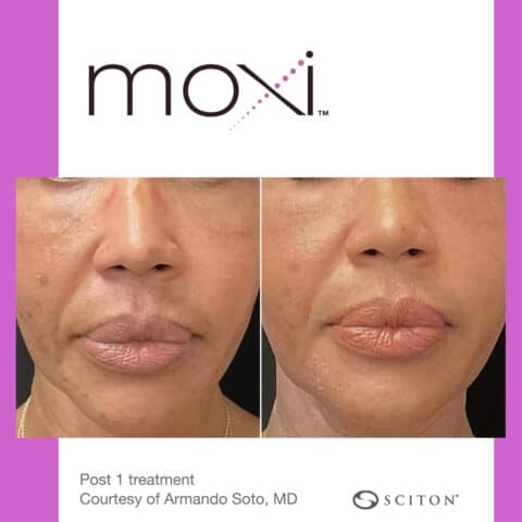 MOXI Laser Treatment | Illume Cosmetic Surgery & MedSpa