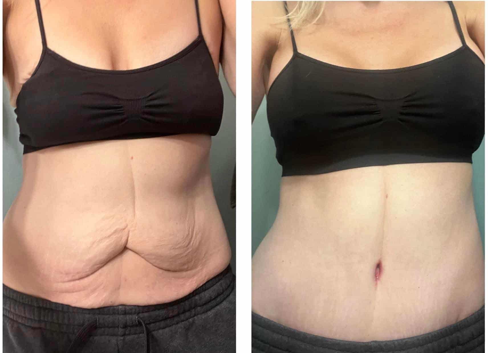 Plus Size Tummy Tuck, try to feel comfortable in my own skin. :  r/PlasticSurgery