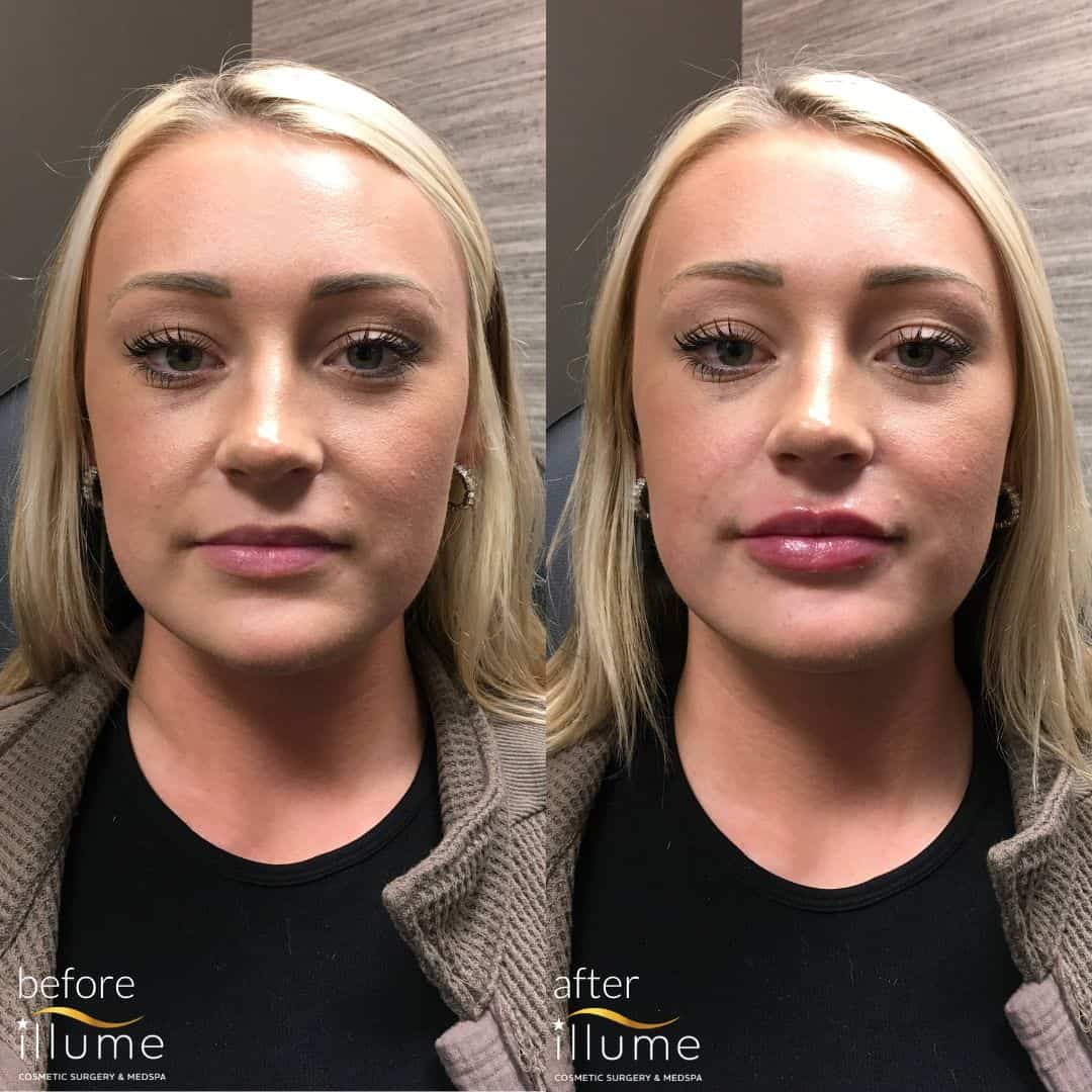 lip injections before and after