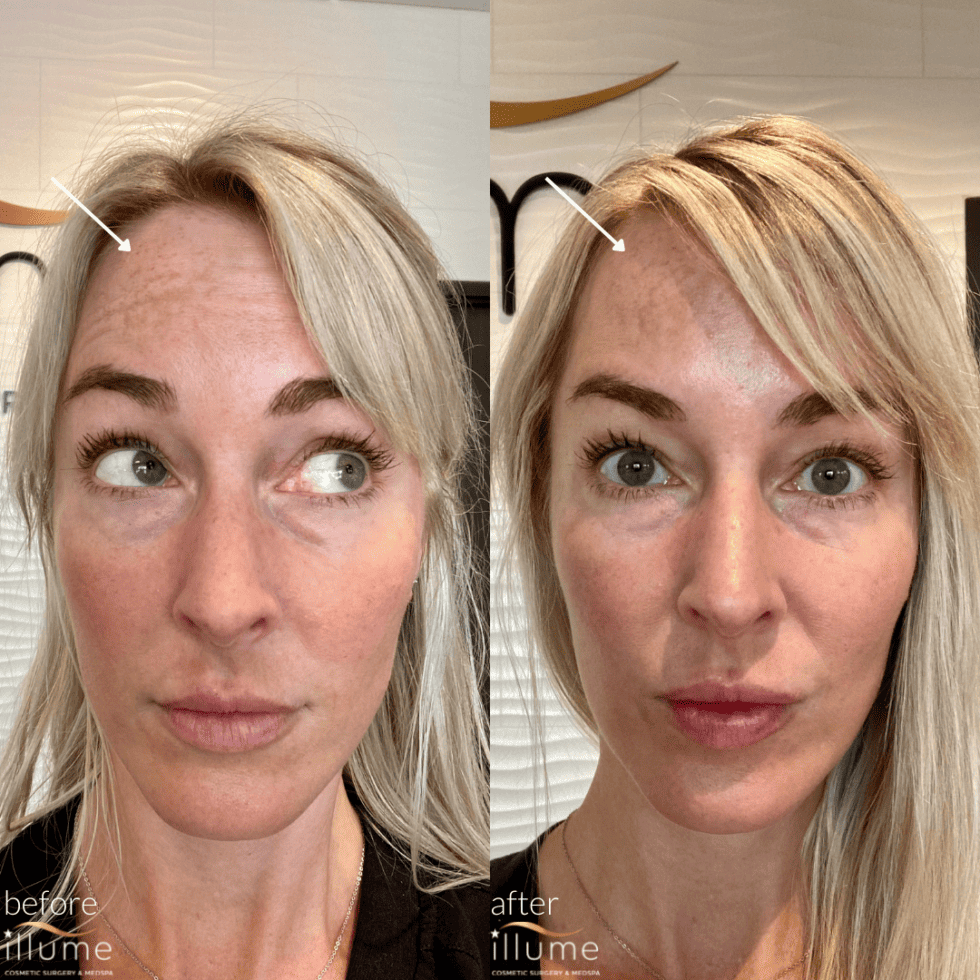 Botox Before & After Photos Illume Cosmetic Surgery & MedSpa
