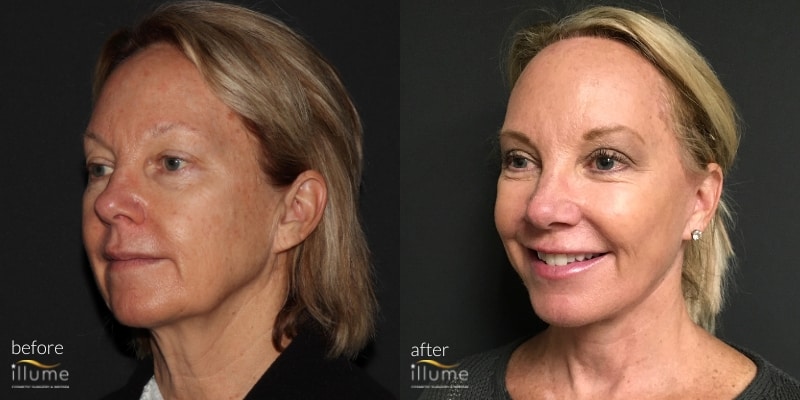 Milwaukee Facelift Illume Cosmetic Surgery And Medspa 