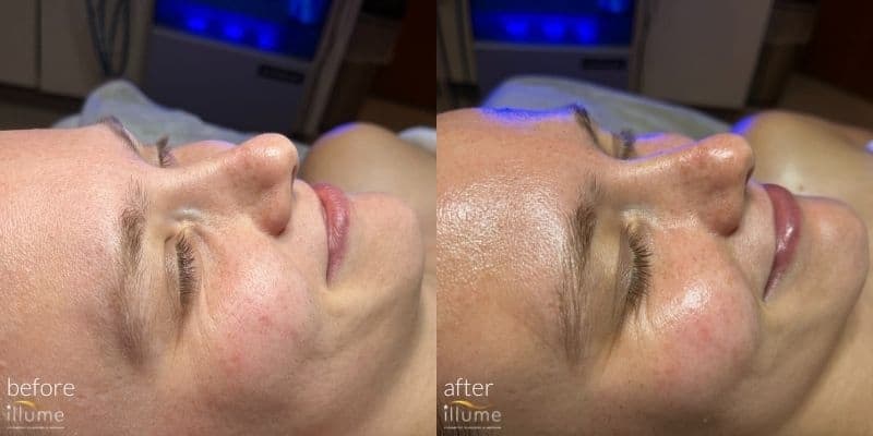 Before & After Illume Hydrafacial MD Treatment