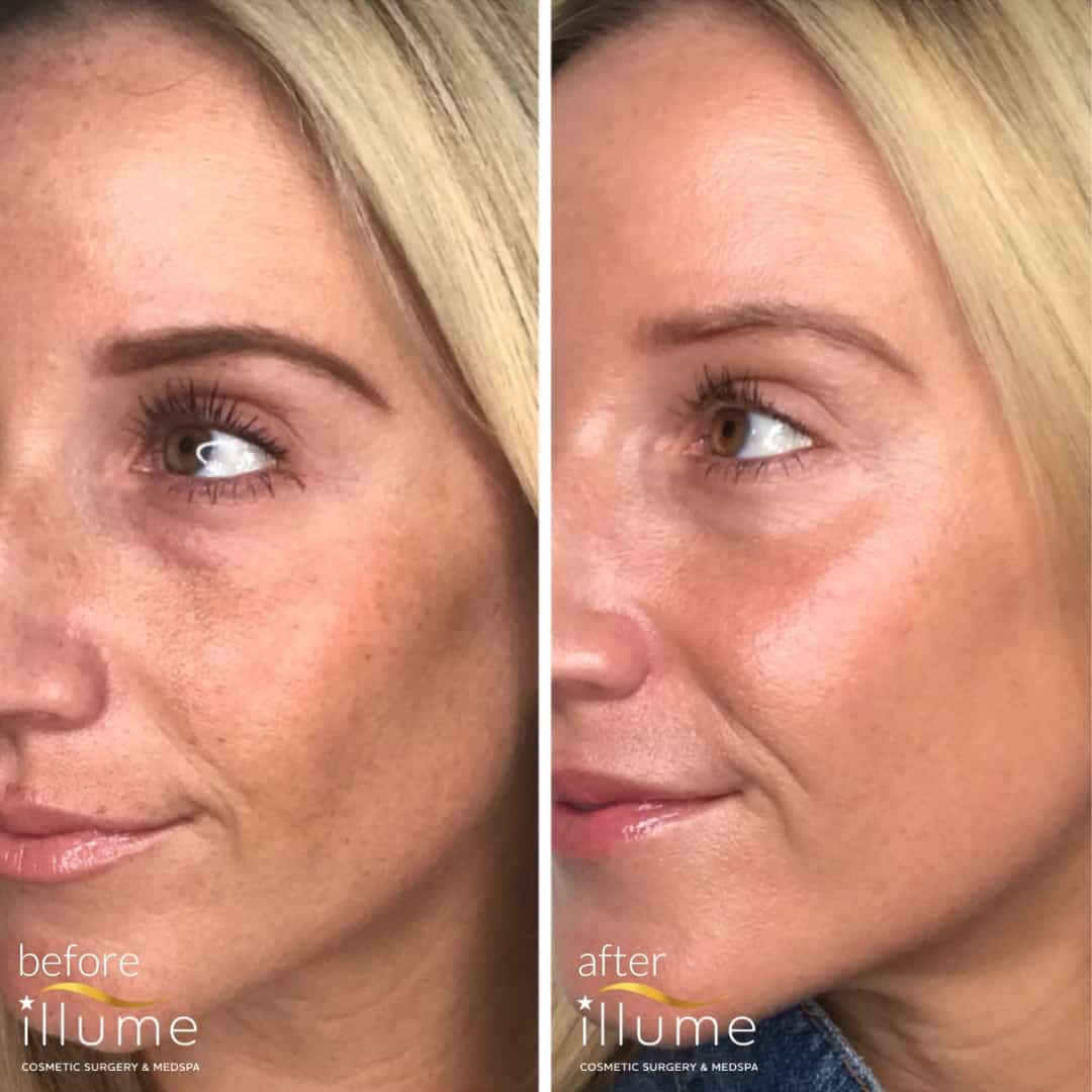 Before and After Halo Hybrid Laser at Illume
