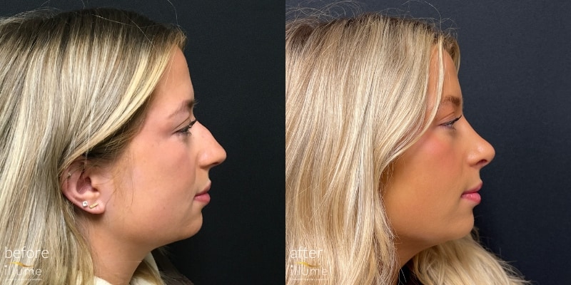 Illume Face Treatment