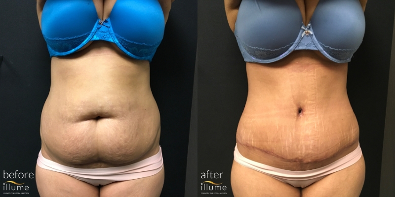 Tummy Tuck Before and After Milwaukee, Cosmetic Surgery Waukesha, Board  Certified Plastic Surgeons Wisconsin, Stomach Skin Tightening Brookfield