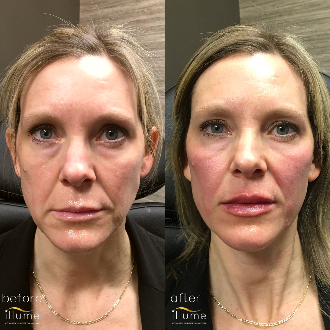 Facial Filler B&A Medspa