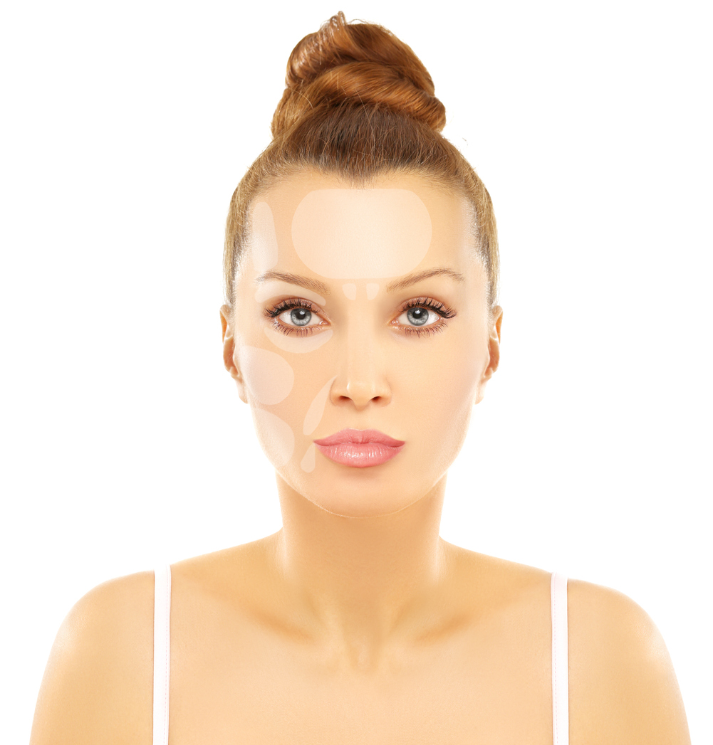 A womans face showing areas facial fat transfer is placed