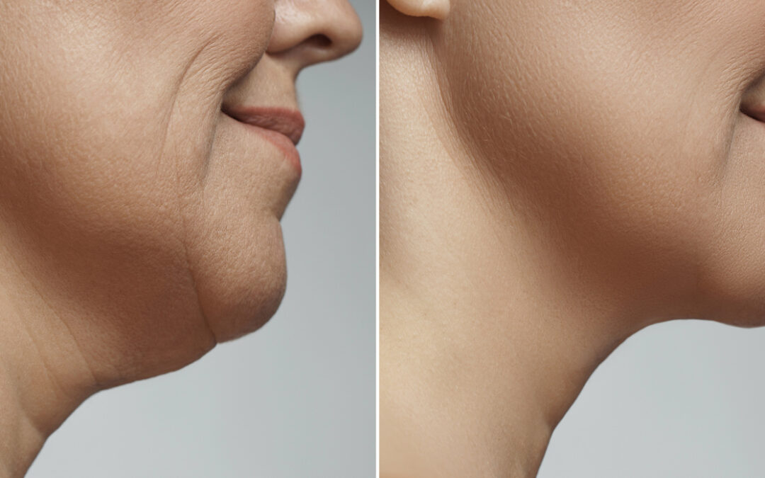 An up close angle of a before and after double chin procedure