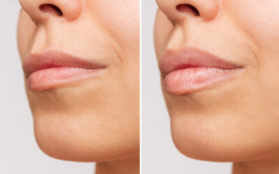 Lip Flip vs. Lip Filler: Key Differences, Benefits, and What’s Right for You