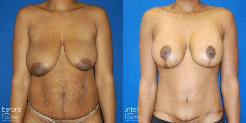 Mommy Makeover at Illume Before-and-after comparison of a female patient's body following a tummy tuck and breast lift procedure, showcasing a smoother abdomen and uplifted breasts at Illume Cosmetic Surgery.