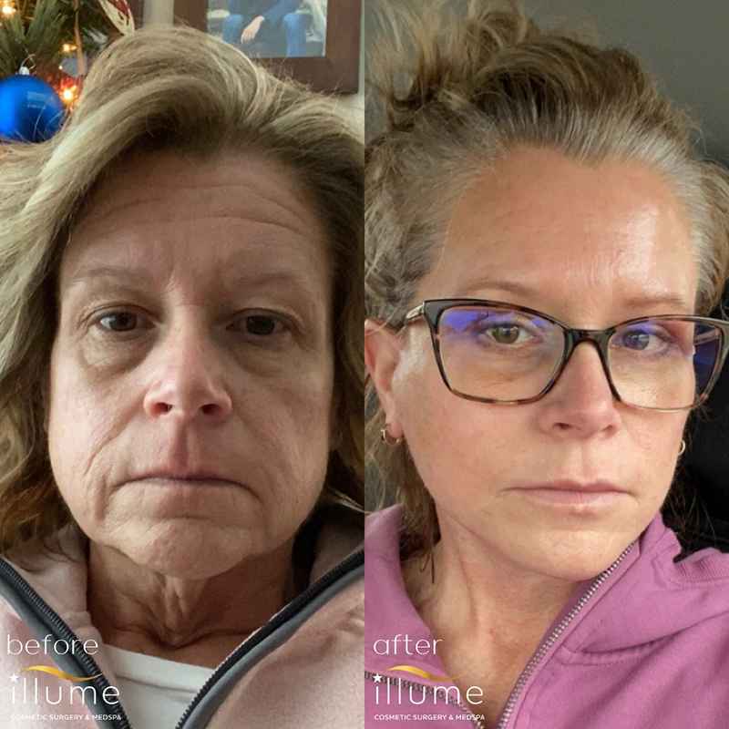 Illume Facelift Before and After