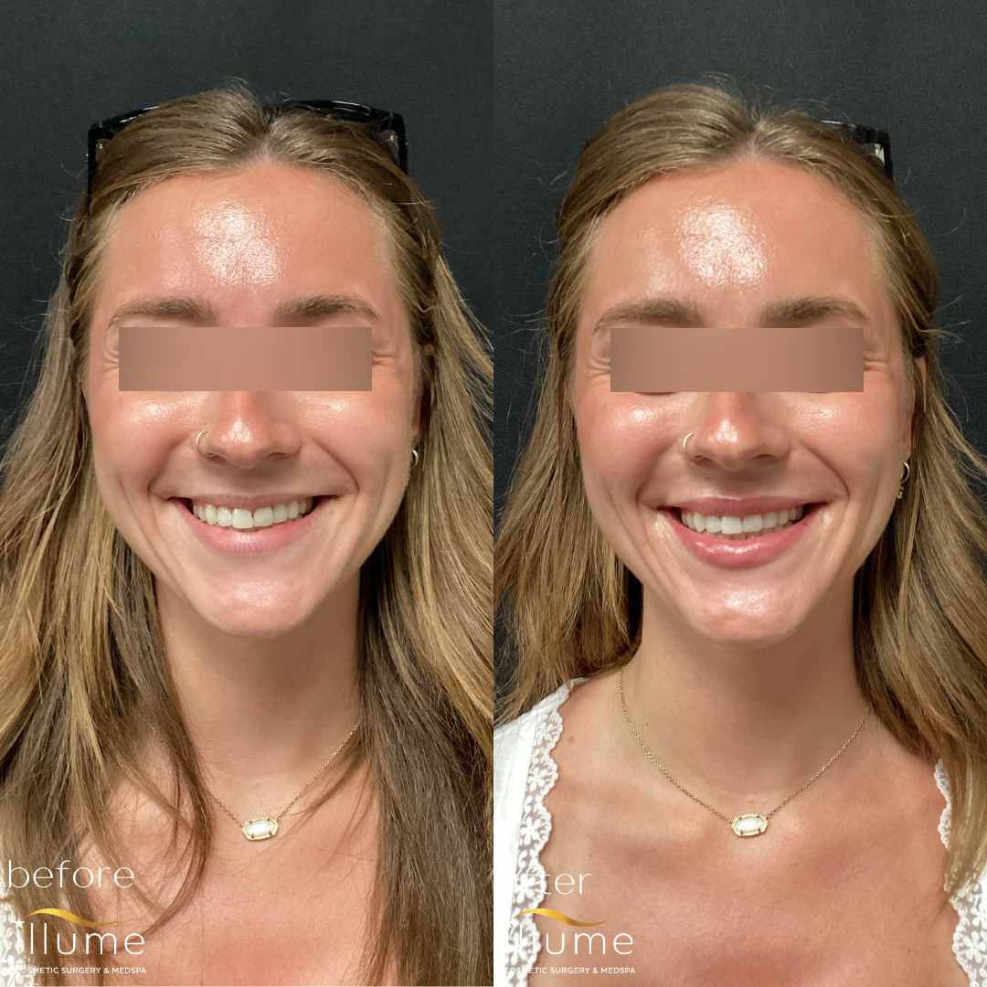 Illume Lip Filler Blonde woman's face before and after lip augmentation cosmetic procedure at Illume Cosmetic Surgery showing enhanced lip volume.