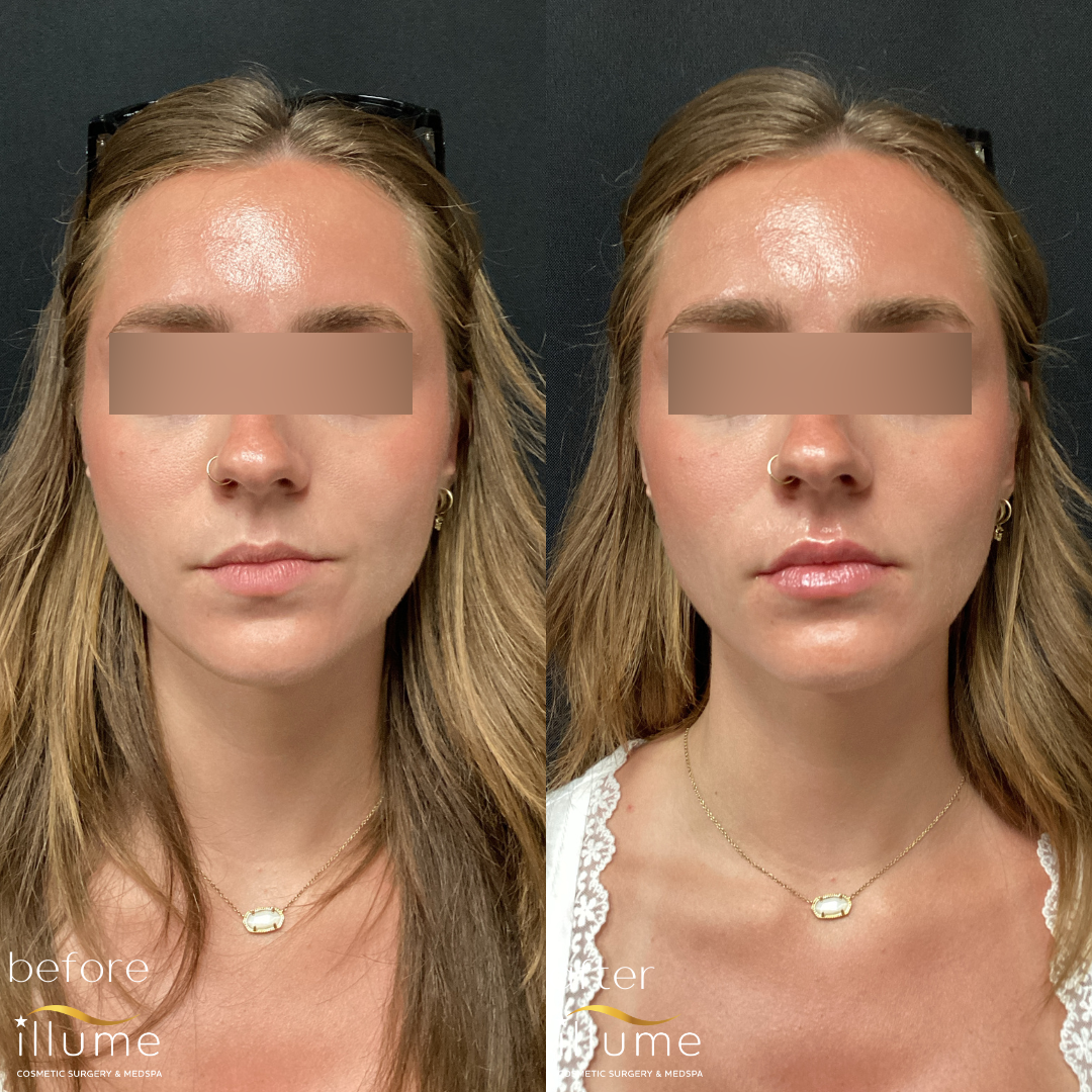 Illume Lip Filler Blonde woman's face before and after lip augmentation cosmetic procedure at Illume Cosmetic Surgery showing enhanced lip volume.
