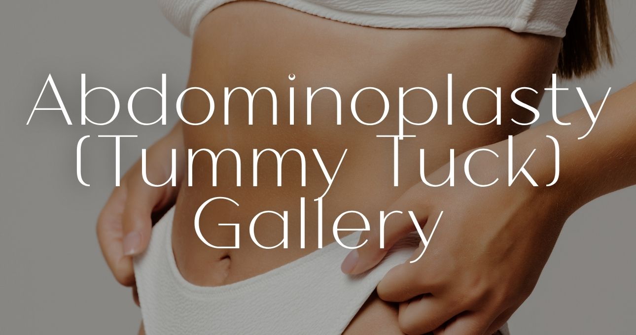 B&A Gallery Abdominoplasty
