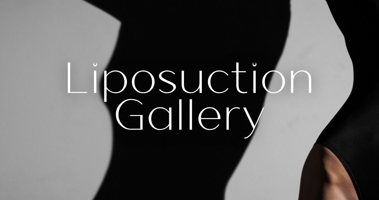 B&A Gallery Liposuction