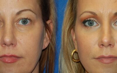 Upper vs. Lower Blepharoplasty: Which Eyelid Concerns Does Each Treat?