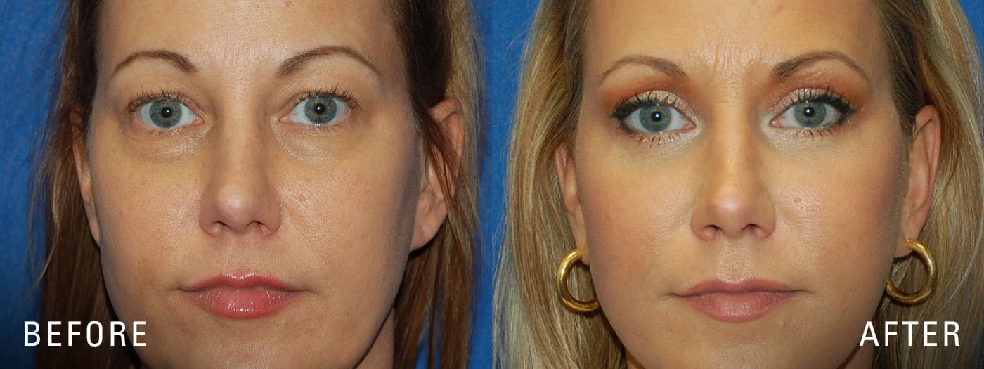 Eyelid surgery before and after