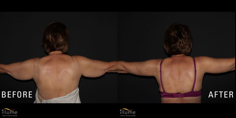 Arm Lift at Illume Rear view before and after of a woman who has undergone an arm lift cosmetic surgery procedure to remove loose skin and improve arm contour at Illume Cosmetic Surgery.