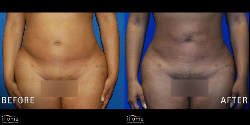 _Illume Website B&A Liposcution (2) Before and after photo showcasing the results of body contouring at Illume Cosmetic Surgery, highlighting improved silhouette.