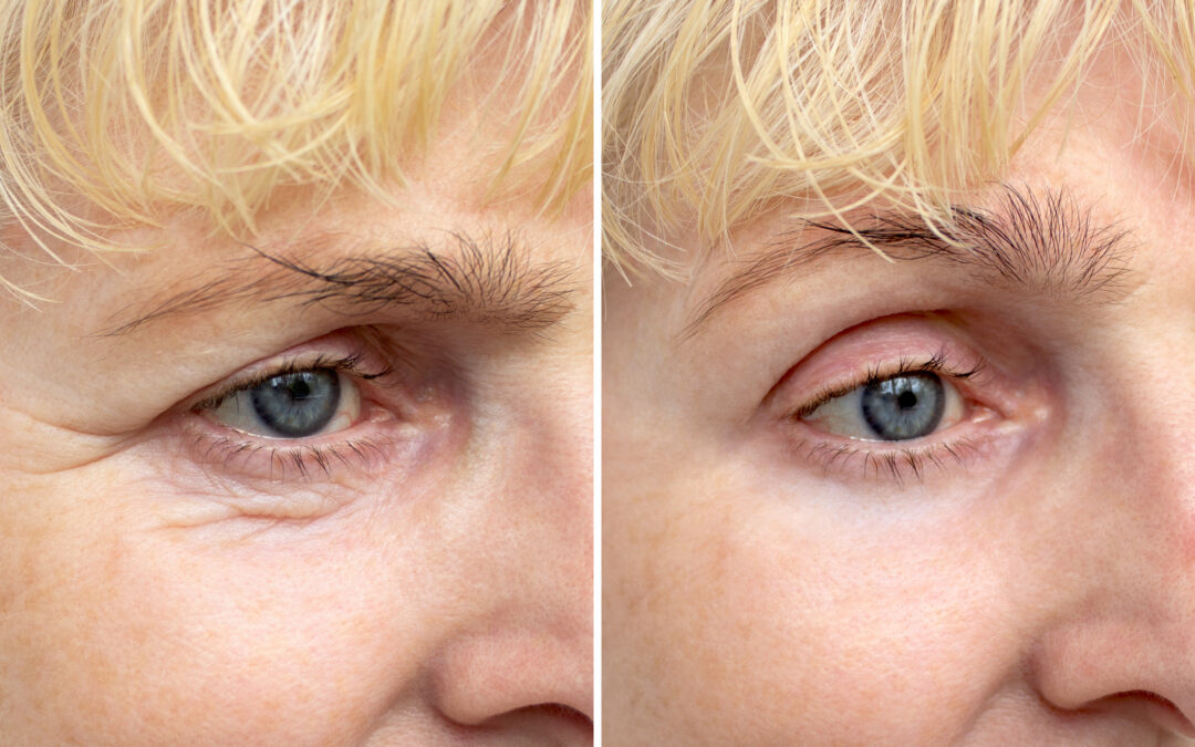 Before and after image of blepharoplasty results